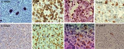 PD-1 and LAG-3 expression in EBV-associated pediatric Hodgkin lymphoma has influence on survival